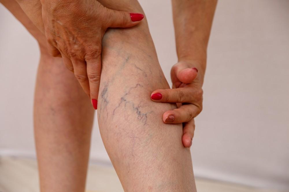 Varicose Veins Beyond Cosmetics: When They Signal Heart Problems